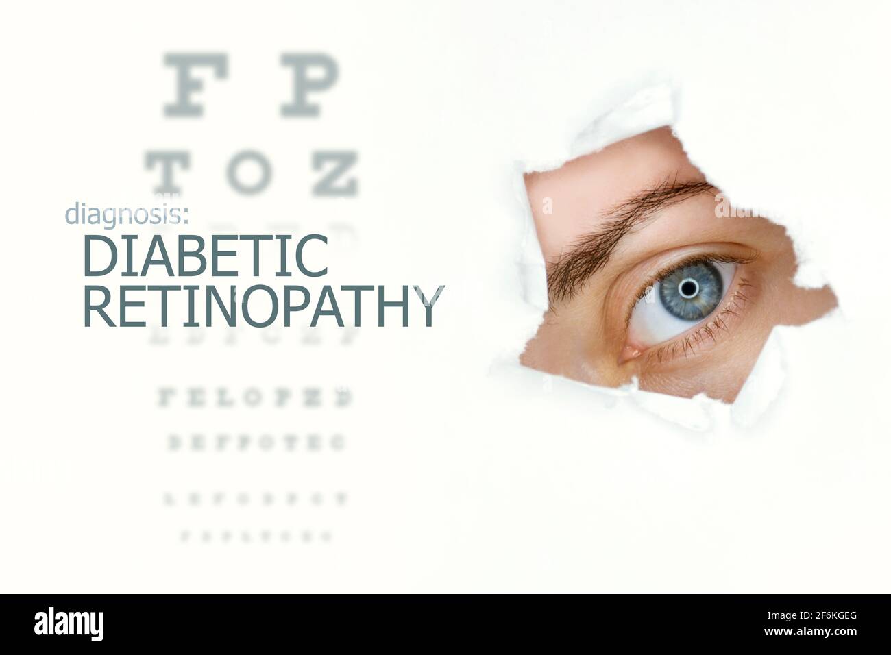 Woman`s eye looking trough teared hole in paper, eye test with words Diabetic Retinopathy on left. Eye disease concept template. Isolated  background. Stock Photo